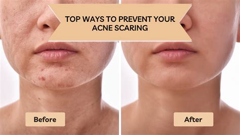 bet way to prevent scarring of acne by smoother clinic